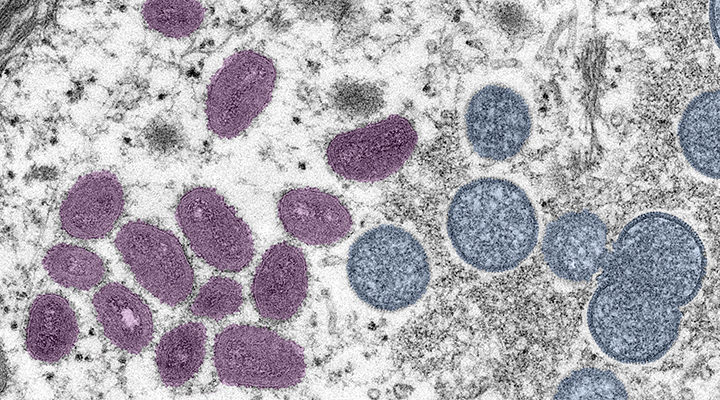 More cases of monkeypox identified in Minnesota - Vimarsana News