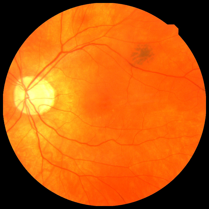 Health Fusion: Eye exams may help predict heart attack - Vimarsana News
