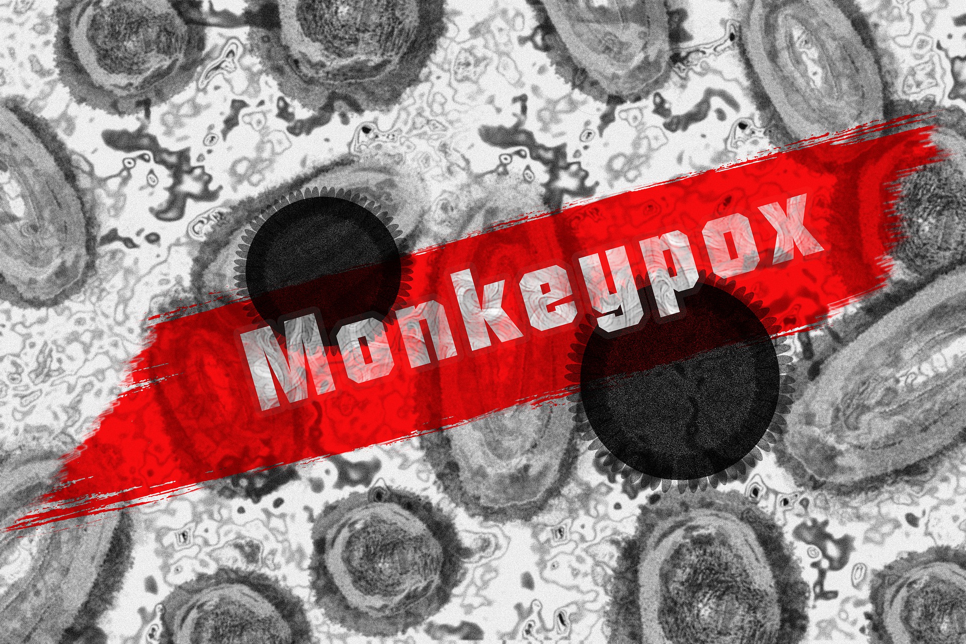One case of monkeypox confirmed in Olmsted County - Vimarsana News